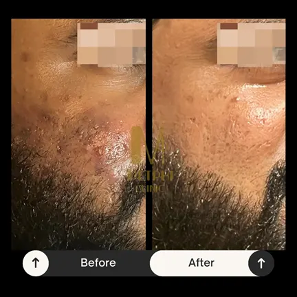 Severe Hormonal Acne Treatment Result