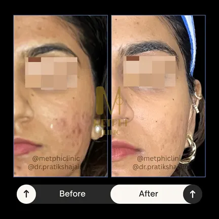 Severe Hormonal Acne Treatment Result