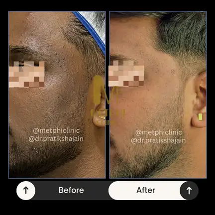 Pigmentation Treatment Result Before and After Cosmelan Peel