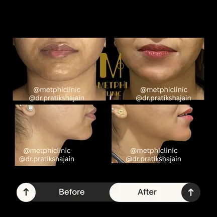 Chin Filler Results Before and After