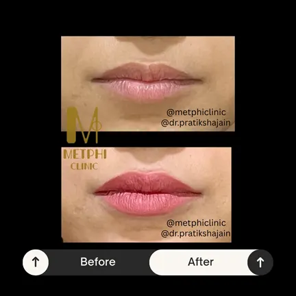 Lip Filler Results Before and After