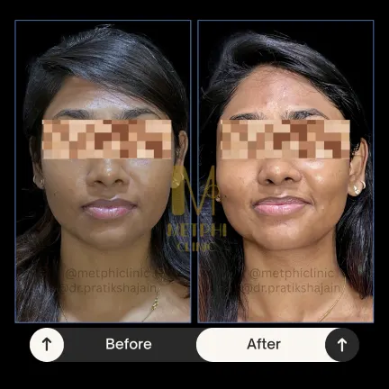 Glutathione IV Drip Results