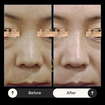 Rhinoplasty Result Before and After