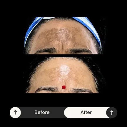 Pigmentation Treatment Result Before and After