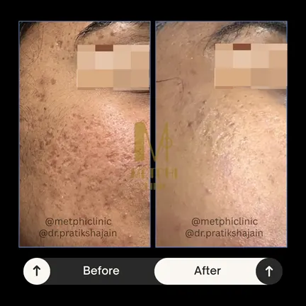 Scar Treatment Result Before and After
