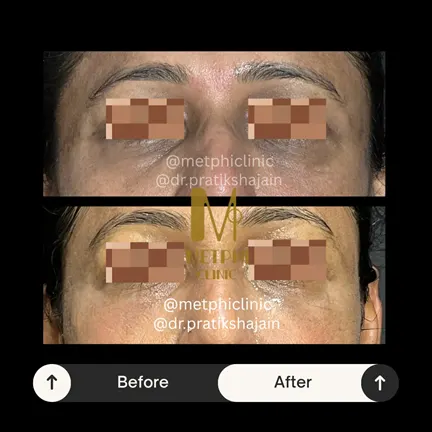 Under Eye Treatment Result Before and After