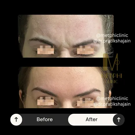 Frown Lines Before and After Results