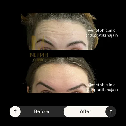 Forehead Lines Before and After Results