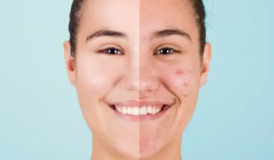 Best Acne Scar Treatments in Bangalore | Metphi Clinic