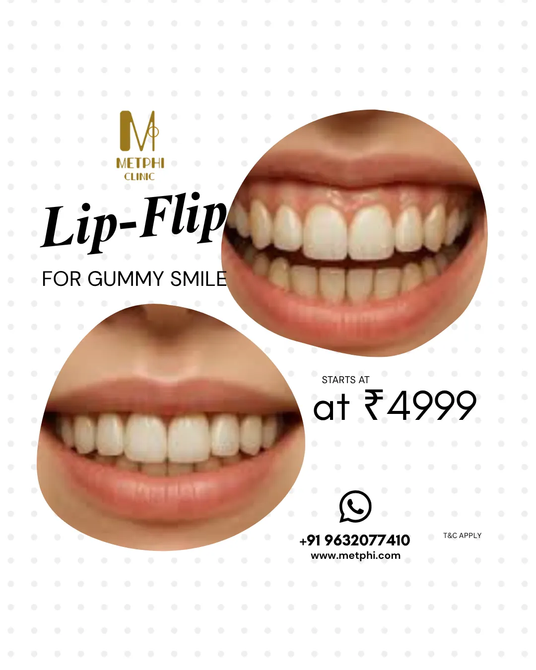 lip-flip-offer
